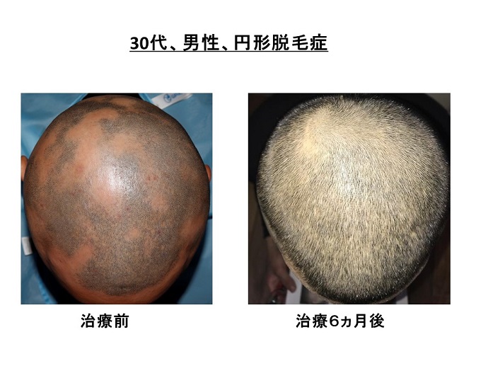 円形脱毛症　病院